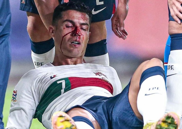 A Cristiano Ronaldo le sangró la nariz sin parar por varios minutos y asustó a todos