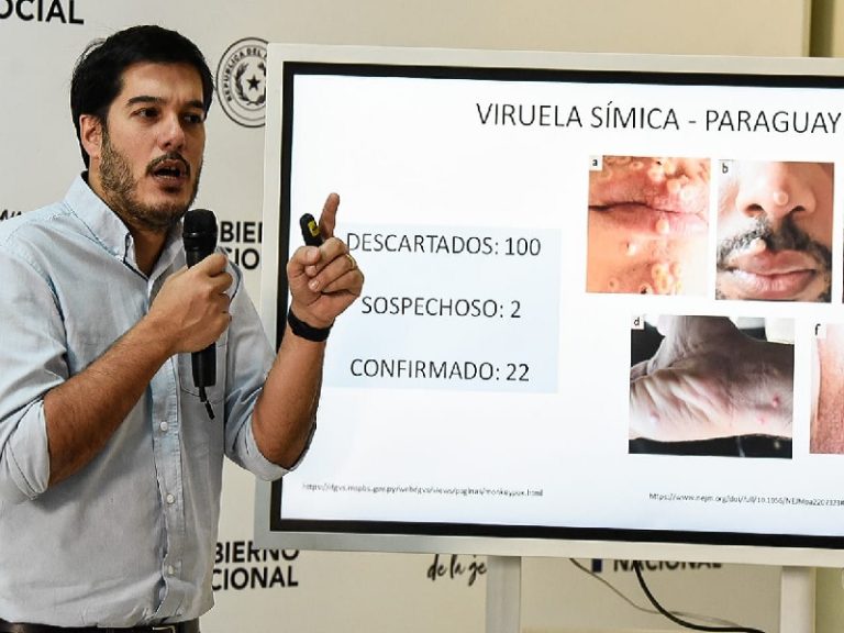 Casos de viruela símica ya llegan a 22, dice Sequera